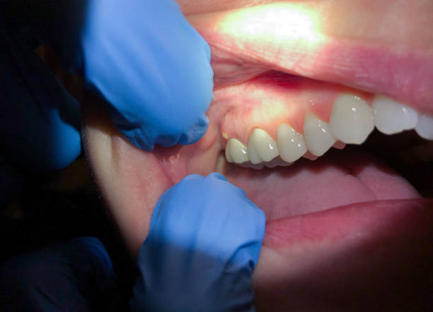 Best Dental Abscess Treatment in Angola, IN
